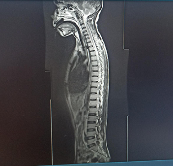 Figure 1 : Brain MRI (T2-weighted axial view) showing hyperintensities in the posterior medulla, suggestive of NMOSD involvement. Figure 1 : Brain MRI (T2-weighted axial view) showing hyperintensities in the posterior medulla, suggestive of NMOSD involvement.