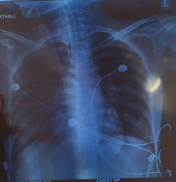 Figure 3 : Chest X-ray (PA view) showing bilateral patchy heterogeneous opacities, most prominent in mid and lower lung zones, suggestive of possible consolidation